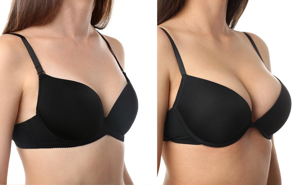 Breast Augmentation | African Medical Services