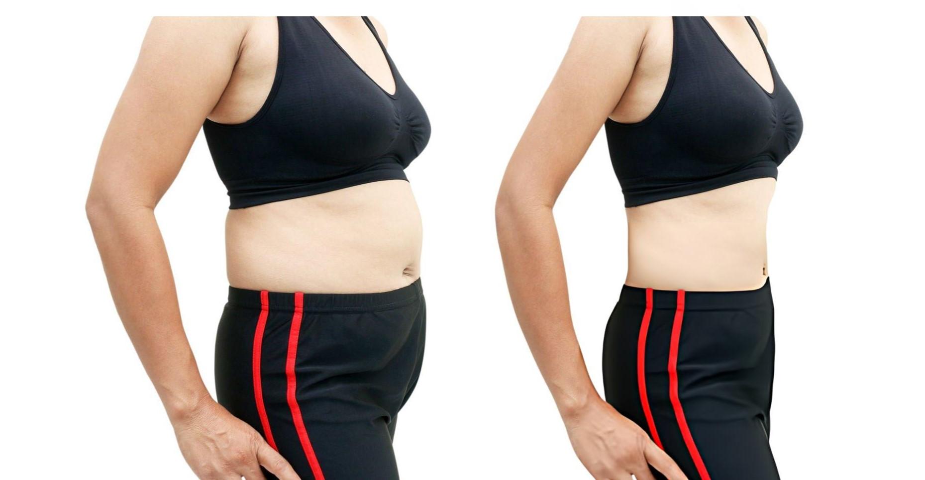 Tummy Tuck (Abdominoplasty) | African Medical Services