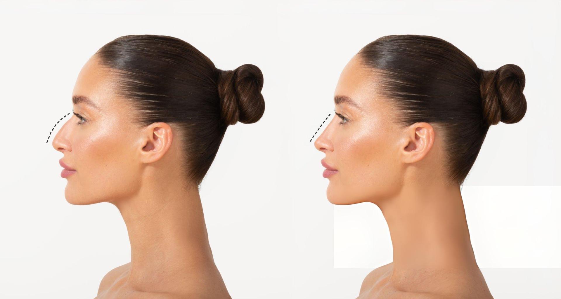 Nose Correction (Rhinoplasty)